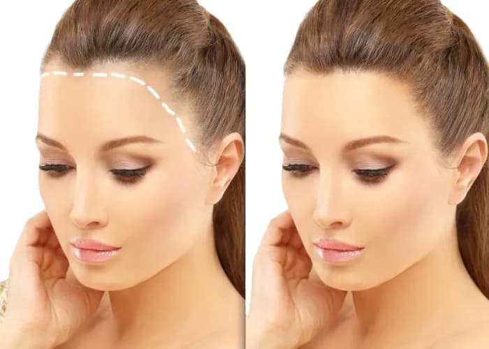 Turkey Hair Transplant Cost at Vivid Clinic Explained